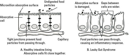 Síndrome del trigo y del intestino permeable