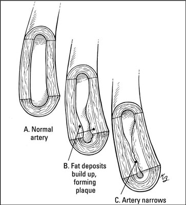 El componente colesterol de las enfermedades cardiovasculares